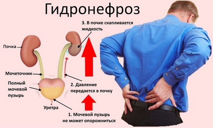 Гидронефроз почек у новорожденных как лечить Гидронефроз почек у новорожденных как лечить