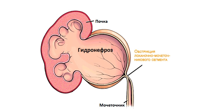 Гидронефроз почек фото