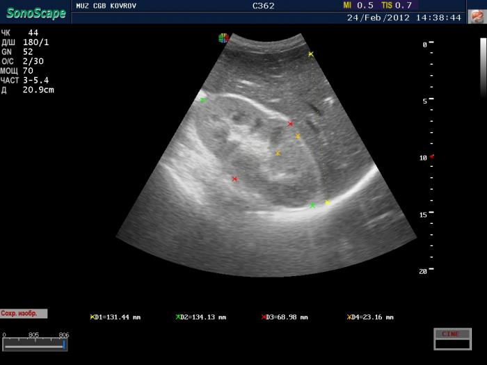 Гломерулонефрит на узи фото