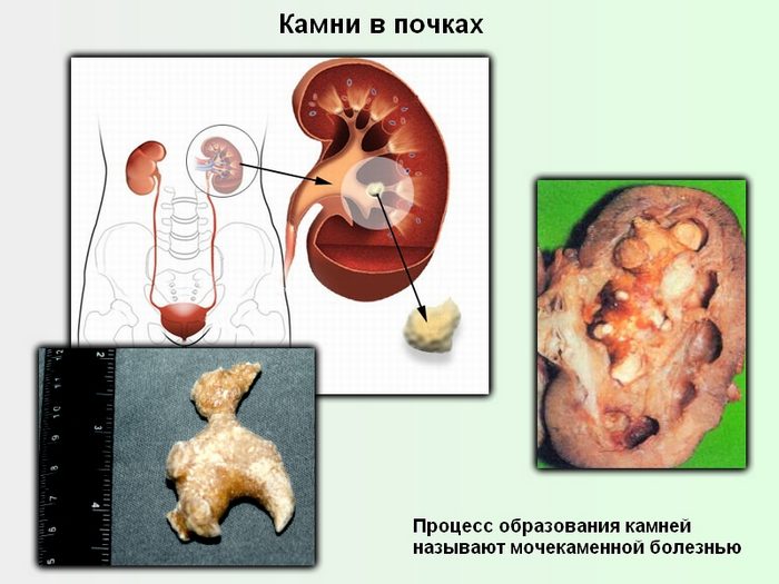 камни в почках у мужчин