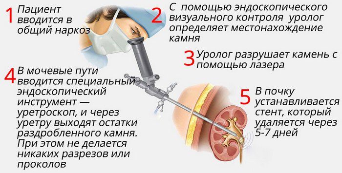 В борьбе с коралловидными камнями используется самый радикальный метод из всех малоинвазивных технологий – чрескожная литотрипсия литотрипсия камней почек противопоказания
