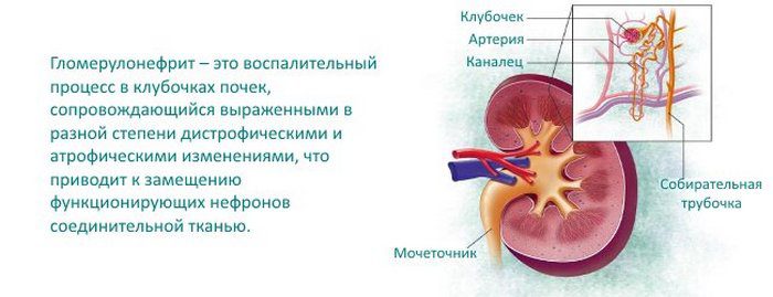 гломерулонефрит и беременность