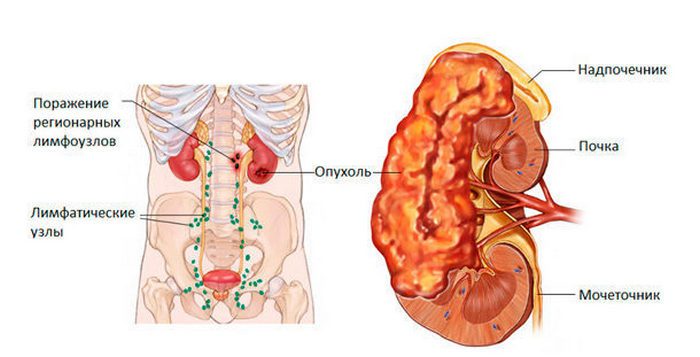 рак почки симптомы признаки у мужчин