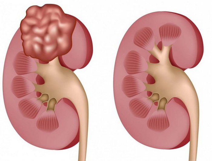 Аденома почки фото