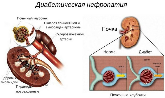 Нефропатия почек — это совокупность патологических почечных состояний, при которых нарушается фильтрующая способность почек нефропатия что это такое