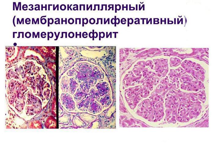 Острый гломерулонефрит картинки