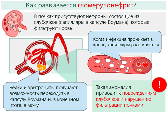 Гломерулонефрит — иммуноаллергическая патология, которая занимает третье место среди всех заболеваний почек гломерулонефрит патогенез
