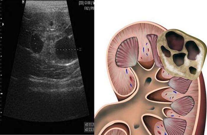 паренхиматозная киста почки