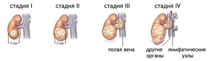 рак почки симптомы