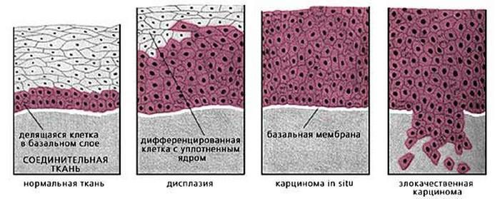 гипернефроидный рак почки