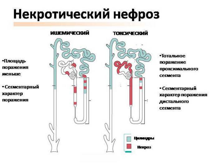 некротический нефроз и микропрепарат