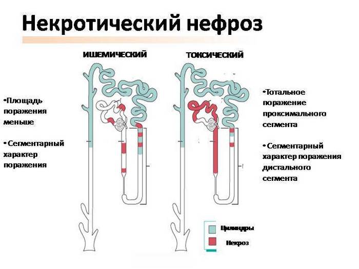 Некротический фасциит фото