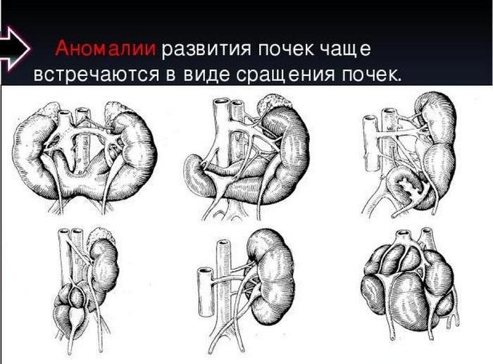 Аномалии развития почки картинки