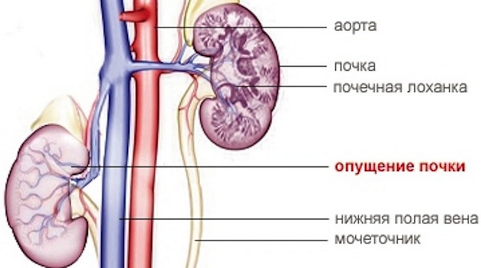 повышенная подвижность правой почки