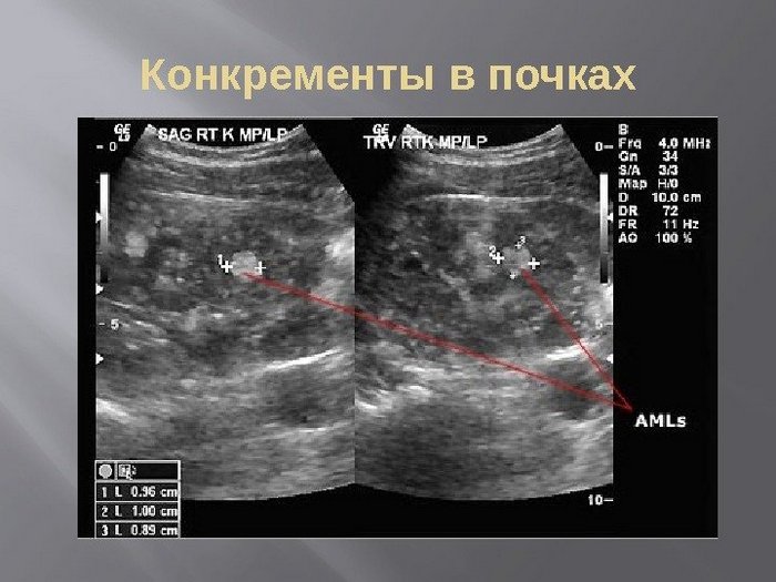 конкременты в почках что это