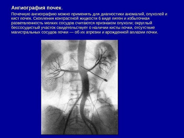 Ангиография почек – это рентгенологический вариант исследования кровеносных сосудов органов фильтрации ангиография почек
