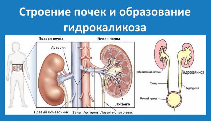 Гидрокаликоз - патология, способная привести к серьезным нарушениям мочевыделительной системы большая почечная чашка