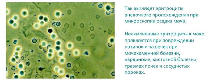 повышенное содержание эритроцитов в моче у женщин