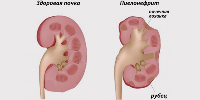 ЧЛС почек и что это такое: расширение чашечно лоханочной системы