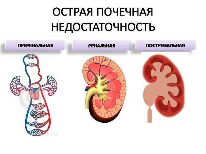 Острая почечная недостаточность – болезнь почек, лечение которой направлено на восстановление функций почечной паренхимы почки симптомы болезни
