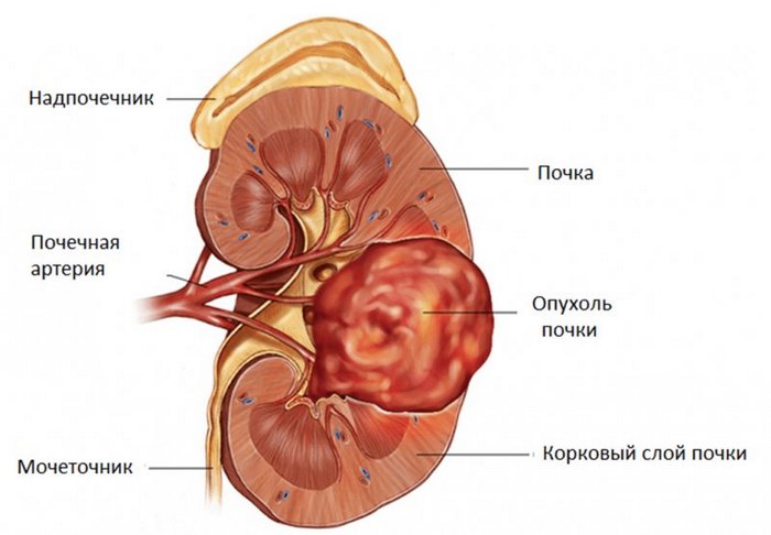 опухоль почки